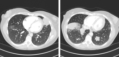 A phase I trial of low-dose inhaled carbon monoxide in sepsis-induced ARDS.