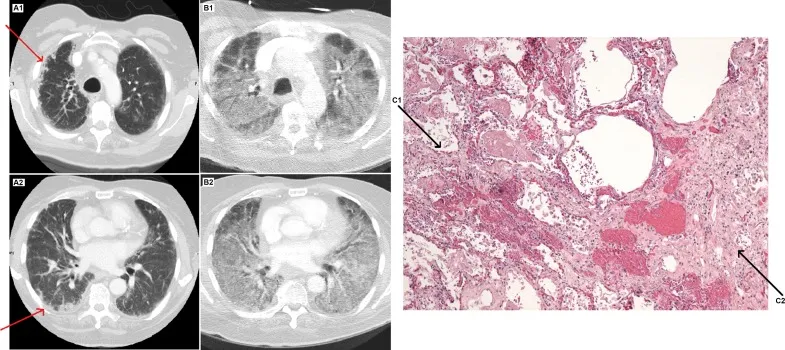 Zinc deficiency primes the lung for ventilator-induced injury.